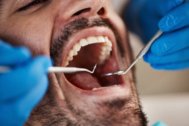 Best Emergency Dental Care for Abscessed Tooth in Aberdeen, MS